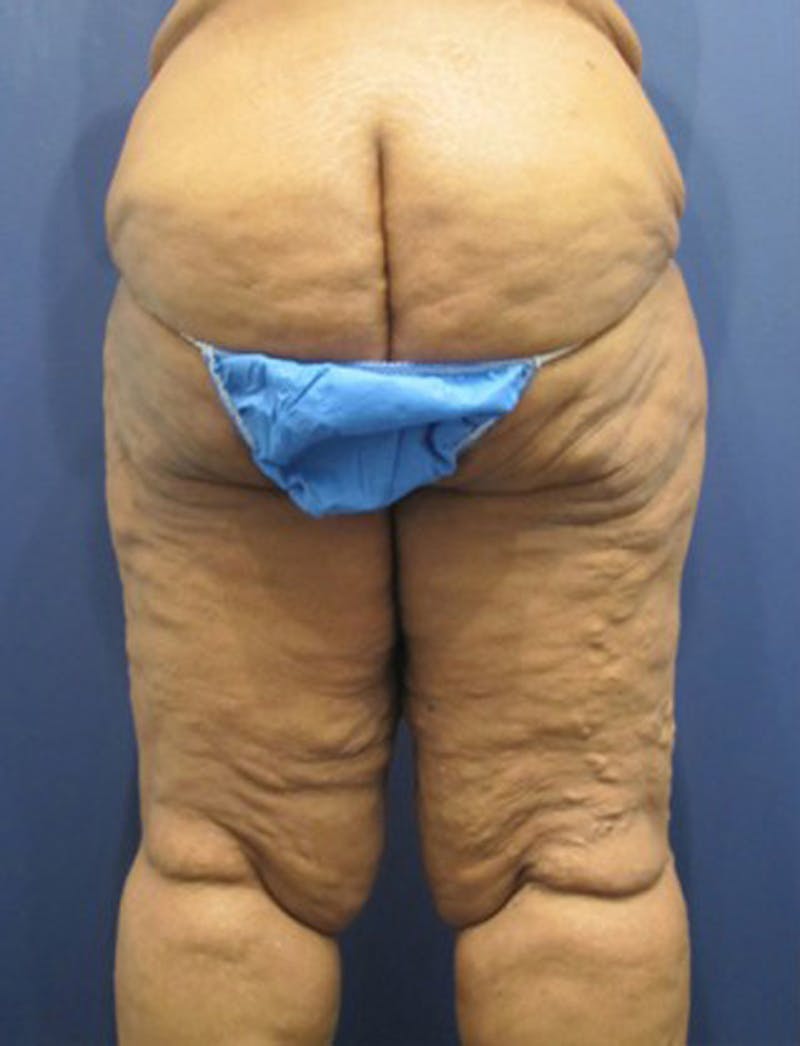 Thigh Lift Before & After Gallery - Patient 174163245 - Image 3