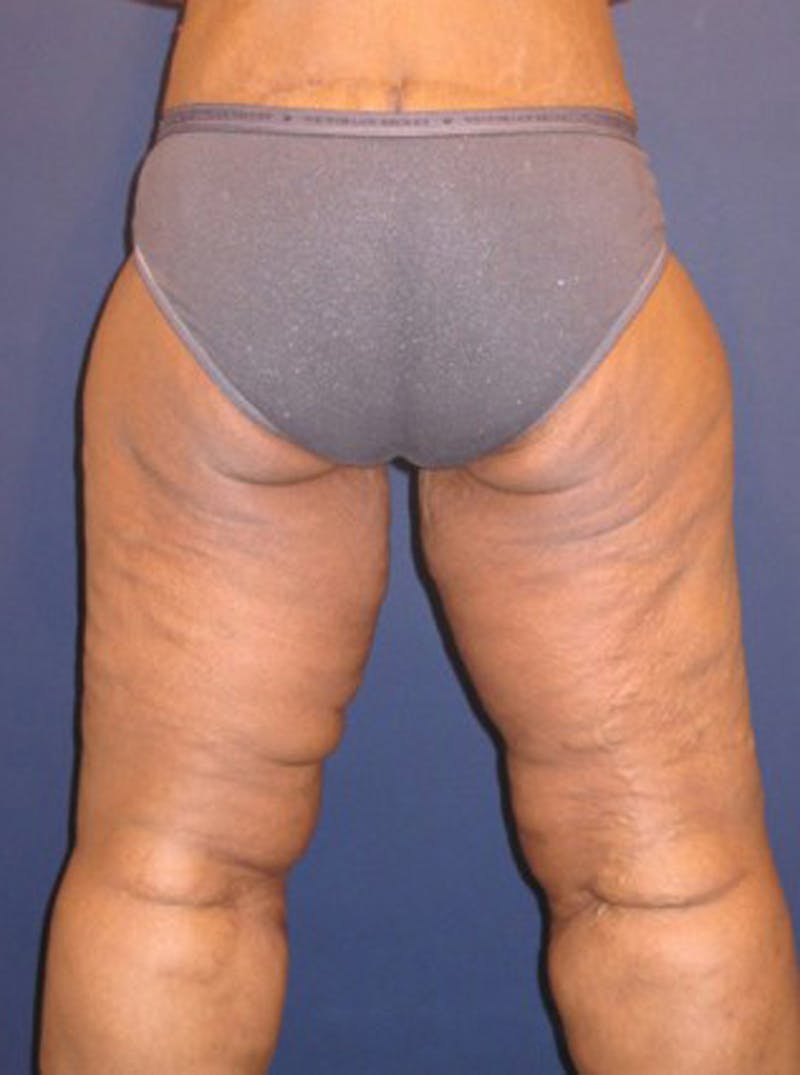 Thigh Lift Before & After Gallery - Patient 174163245 - Image 4