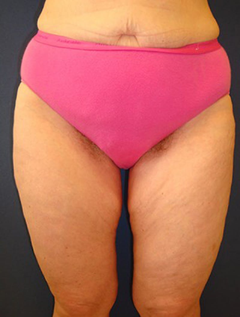 Thigh Lift Before & After Gallery - Patient 174163254 - Image 1