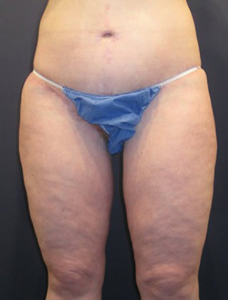 Thigh Lift Before & After Gallery - Patient 174163254 - Image 2
