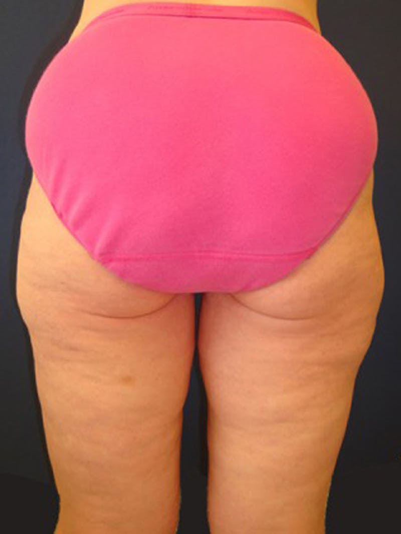 Thigh Lift Before & After Gallery - Patient 174163254 - Image 3