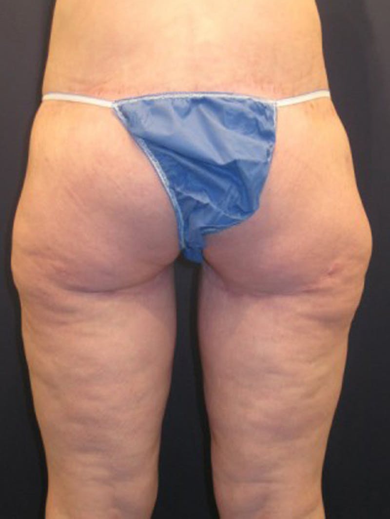 Thigh Lift Before & After Gallery - Patient 174163254 - Image 4