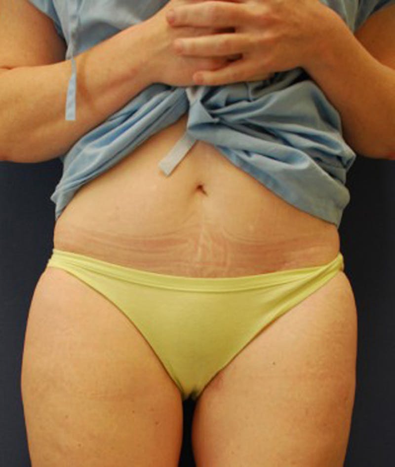 Thigh Lift Before & After Gallery - Patient 174163260 - Image 2