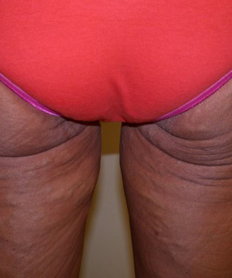 Thigh Lift Before & After Gallery - Patient 174163265 - Image 1