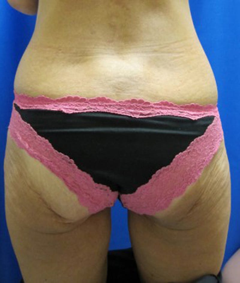 Thigh Lift Before & After Gallery - Patient 174163265 - Image 2