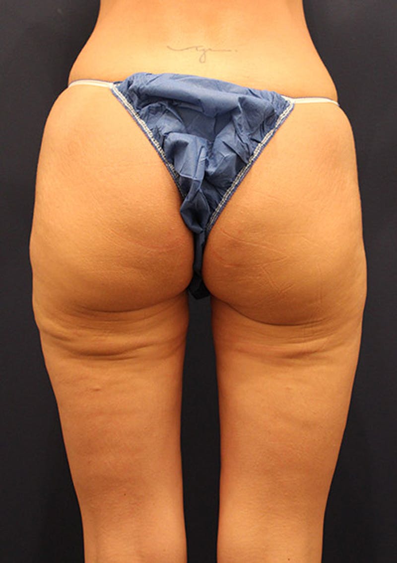 Thigh Lift Before & After Gallery - Patient 174163272 - Image 1
