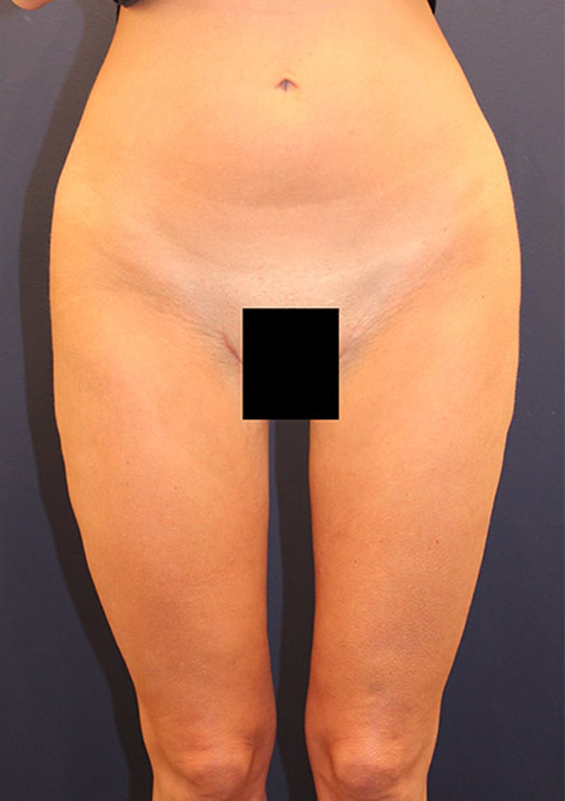 Thigh Lift Before & After Gallery - Patient 174163272 - Image 4