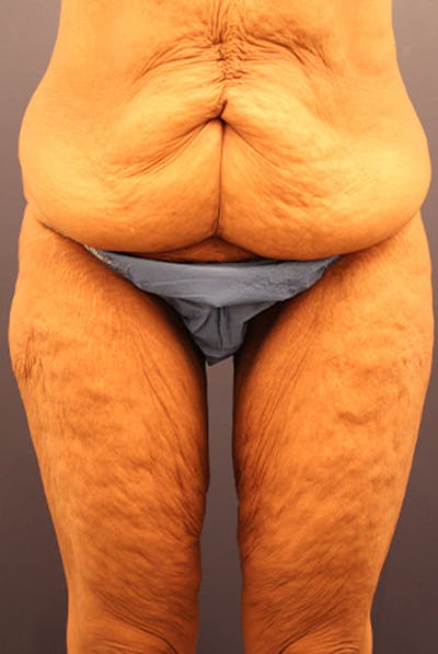 Thigh Lift Before & After Gallery - Patient 174163283 - Image 1