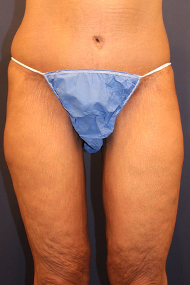 Thigh Lift Before & After Gallery - Patient 174163283 - Image 2