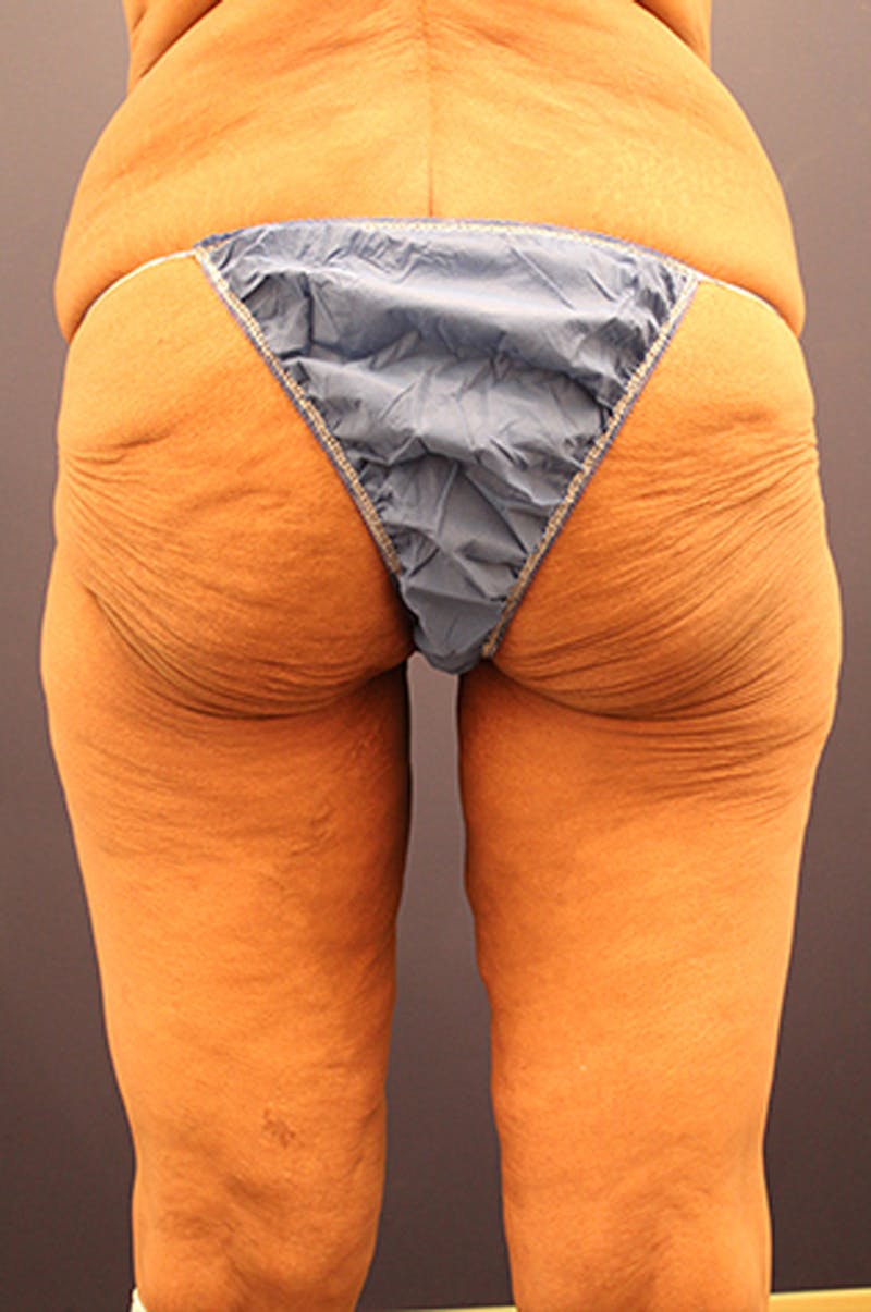 Thigh Lift Before & After Gallery - Patient 174163283 - Image 3