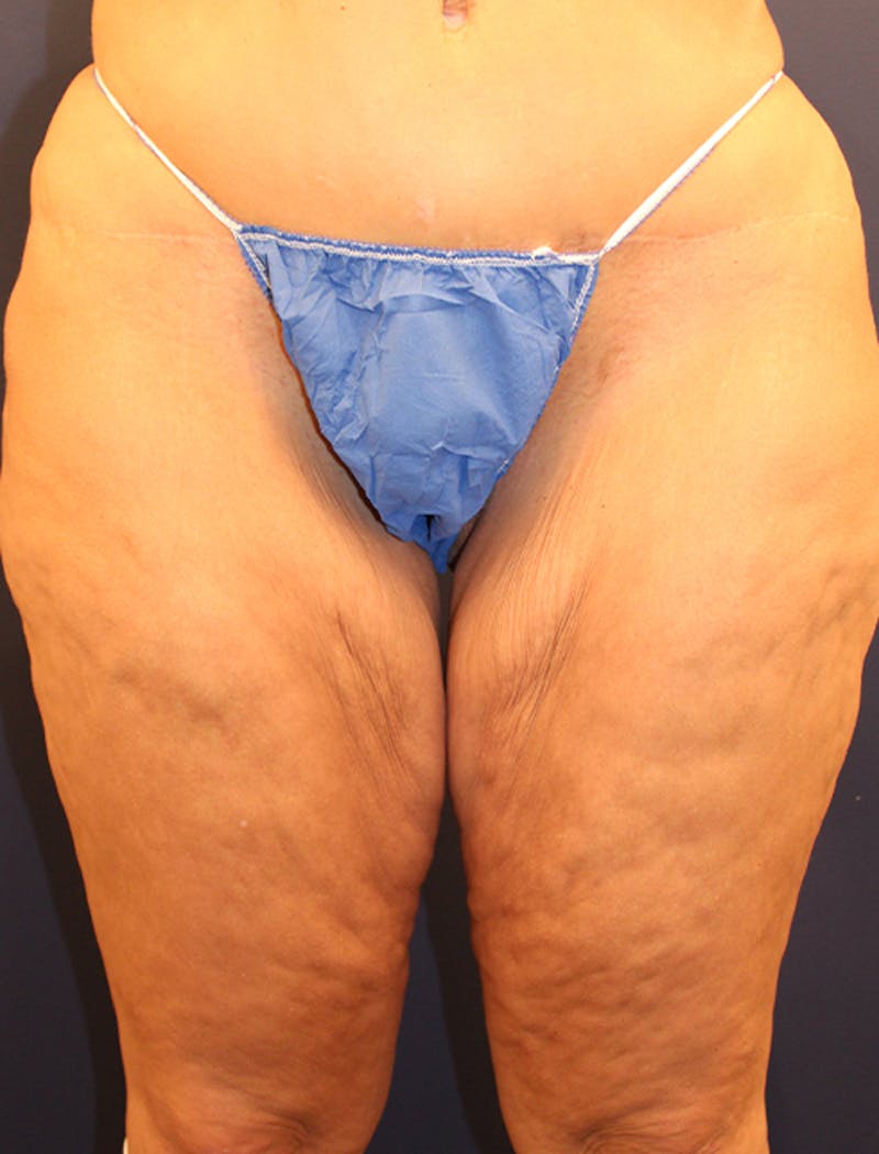 Thigh Lift Before & After Gallery - Patient 174163293 - Image 1