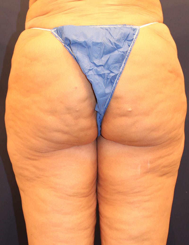Thigh Lift Before & After Gallery - Patient 174163293 - Image 3