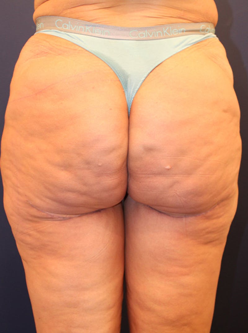 Thigh Lift Before & After Gallery - Patient 174163293 - Image 4