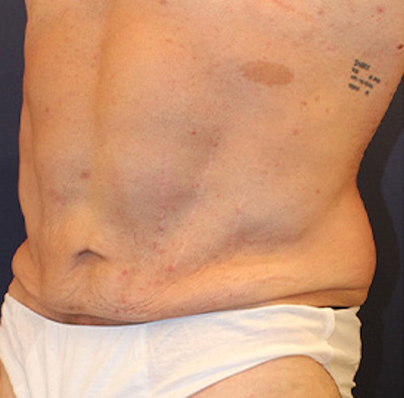 Tummy Tuck Before & After Gallery - Patient 174163166 - Image 1