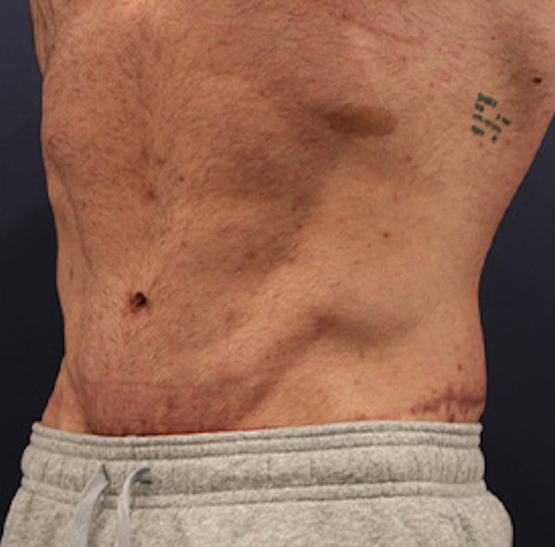 Tummy Tuck Before & After Gallery - Patient 174163166 - Image 4