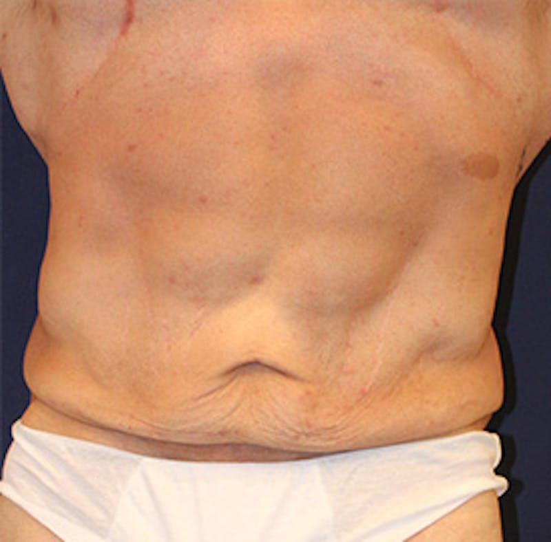 Tummy Tuck Before & After Gallery - Patient 174163166 - Image 1