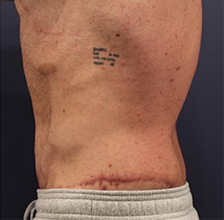 Tummy Tuck Before & After Gallery - Patient 174163166 - Image 6
