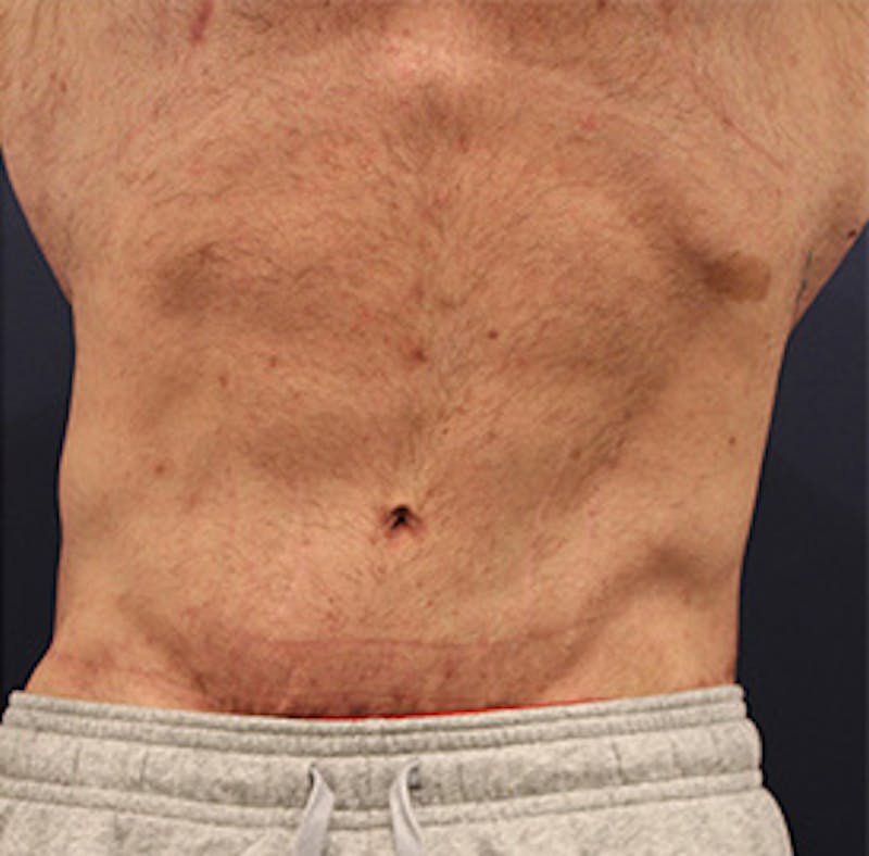 Tummy Tuck Before & After Gallery - Patient 174163166 - Image 2