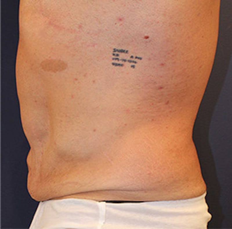Tummy Tuck Before & After Gallery - Patient 174163166 - Image 5