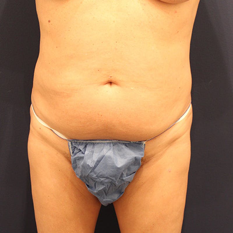 Tummy Tuck Before & After Gallery - Patient 174163173 - Image 1