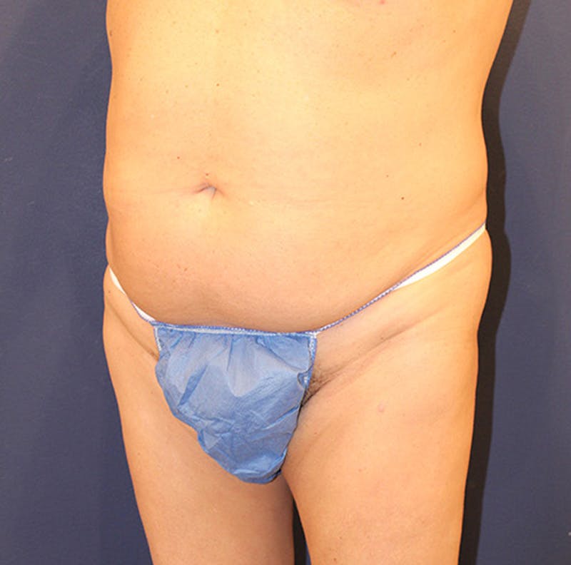 Tummy Tuck Before & After Gallery - Patient 174163173 - Image 3
