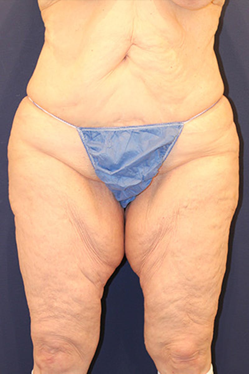 Tummy Tuck Before & After Gallery - Patient 174163179 - Image 1