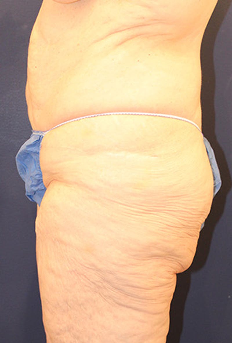 Tummy Tuck Before & After Gallery - Patient 174163179 - Image 3