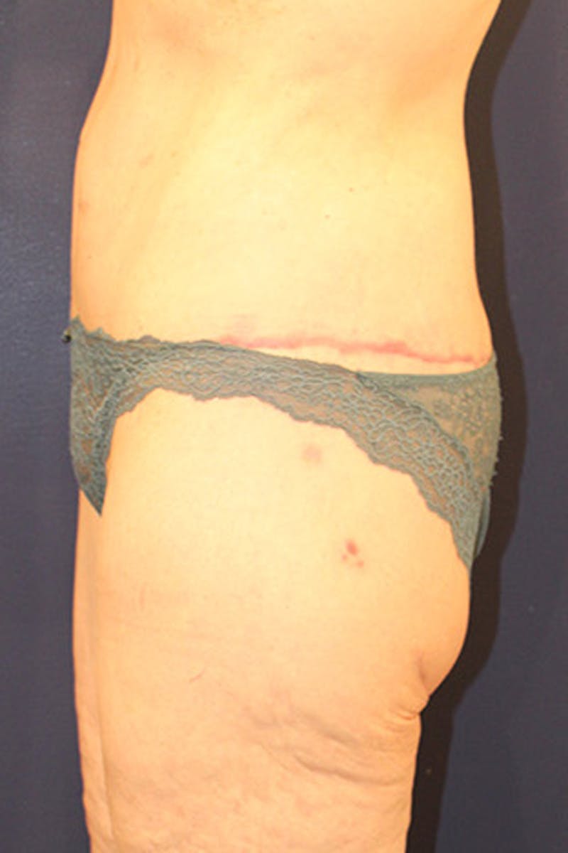 Tummy Tuck Before & After Gallery - Patient 174163179 - Image 4