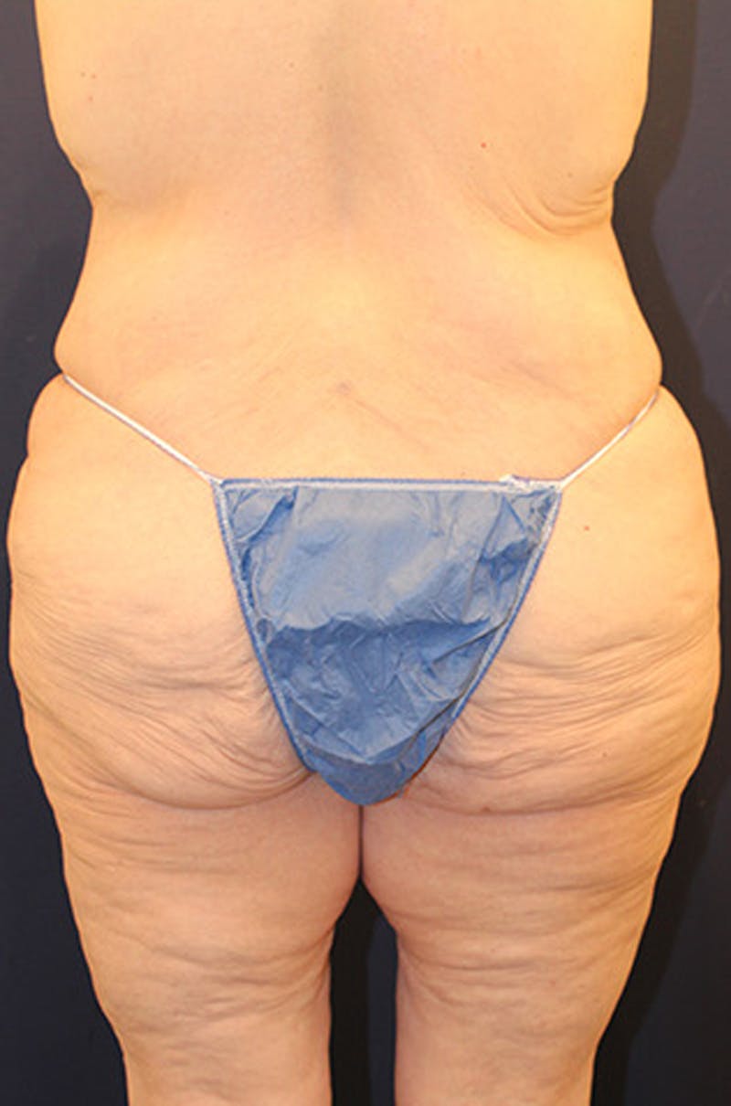 Tummy Tuck Before & After Gallery - Patient 174163179 - Image 5