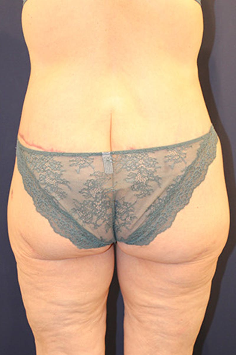 Tummy Tuck Before & After Gallery - Patient 174163179 - Image 6