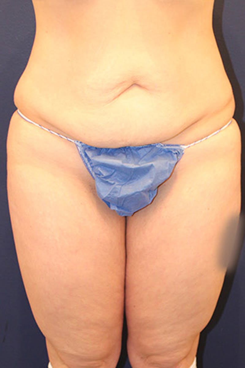 Tummy Tuck Before & After Gallery - Patient 174163193 - Image 1