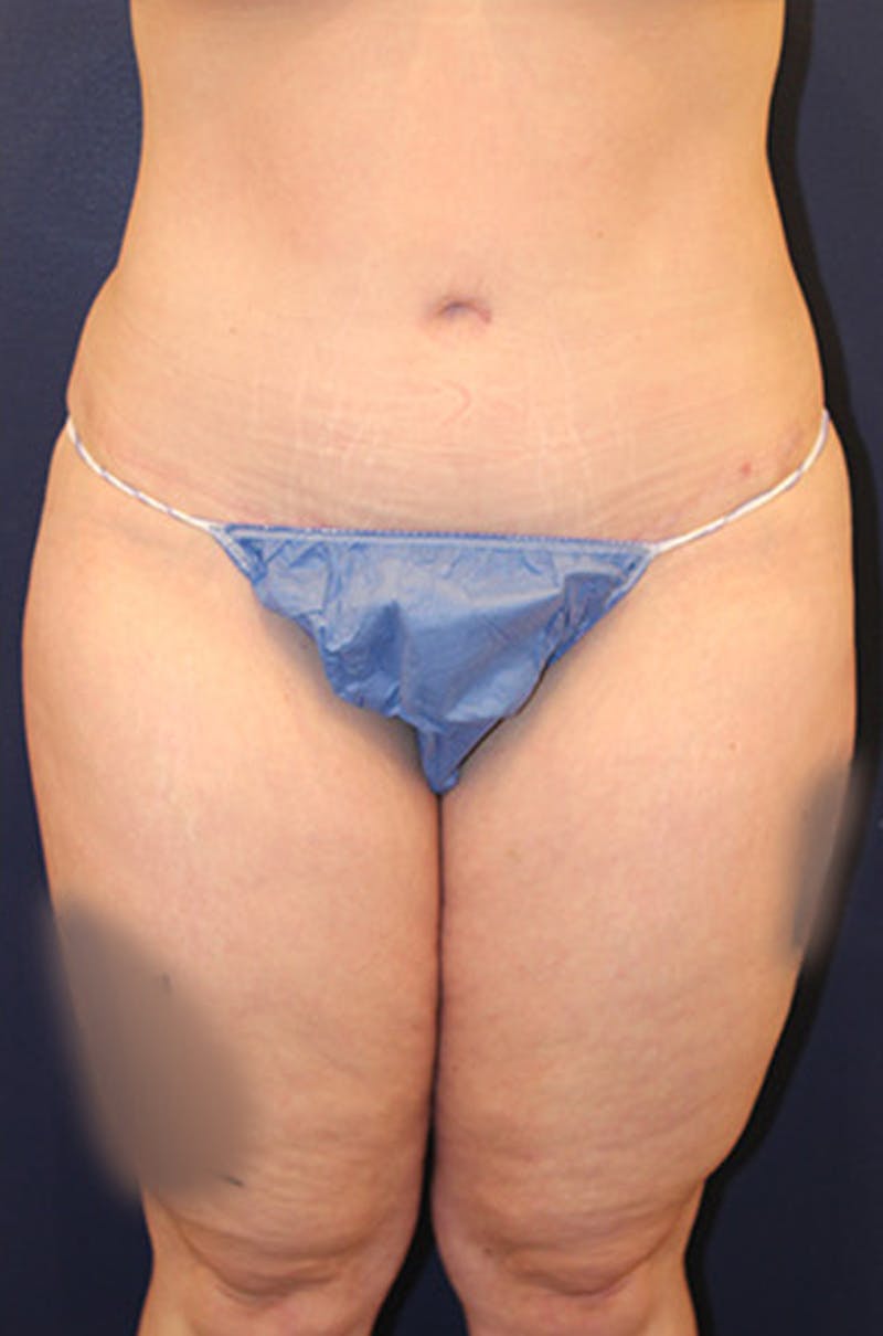 Tummy Tuck Before & After Gallery - Patient 174163193 - Image 2
