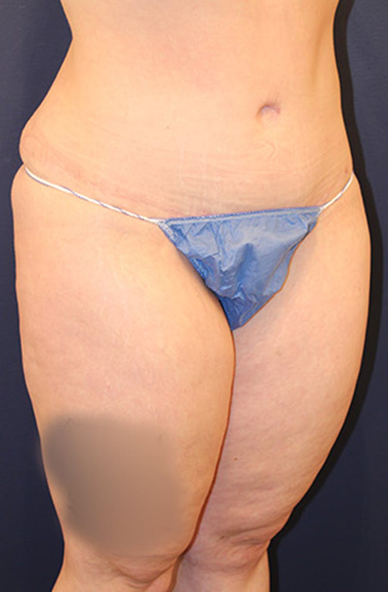 Tummy Tuck Before & After Gallery - Patient 174163193 - Image 4