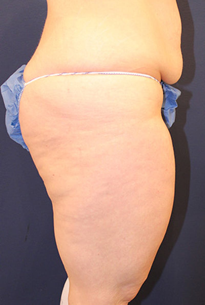 Tummy Tuck Before & After Gallery - Patient 174163193 - Image 5