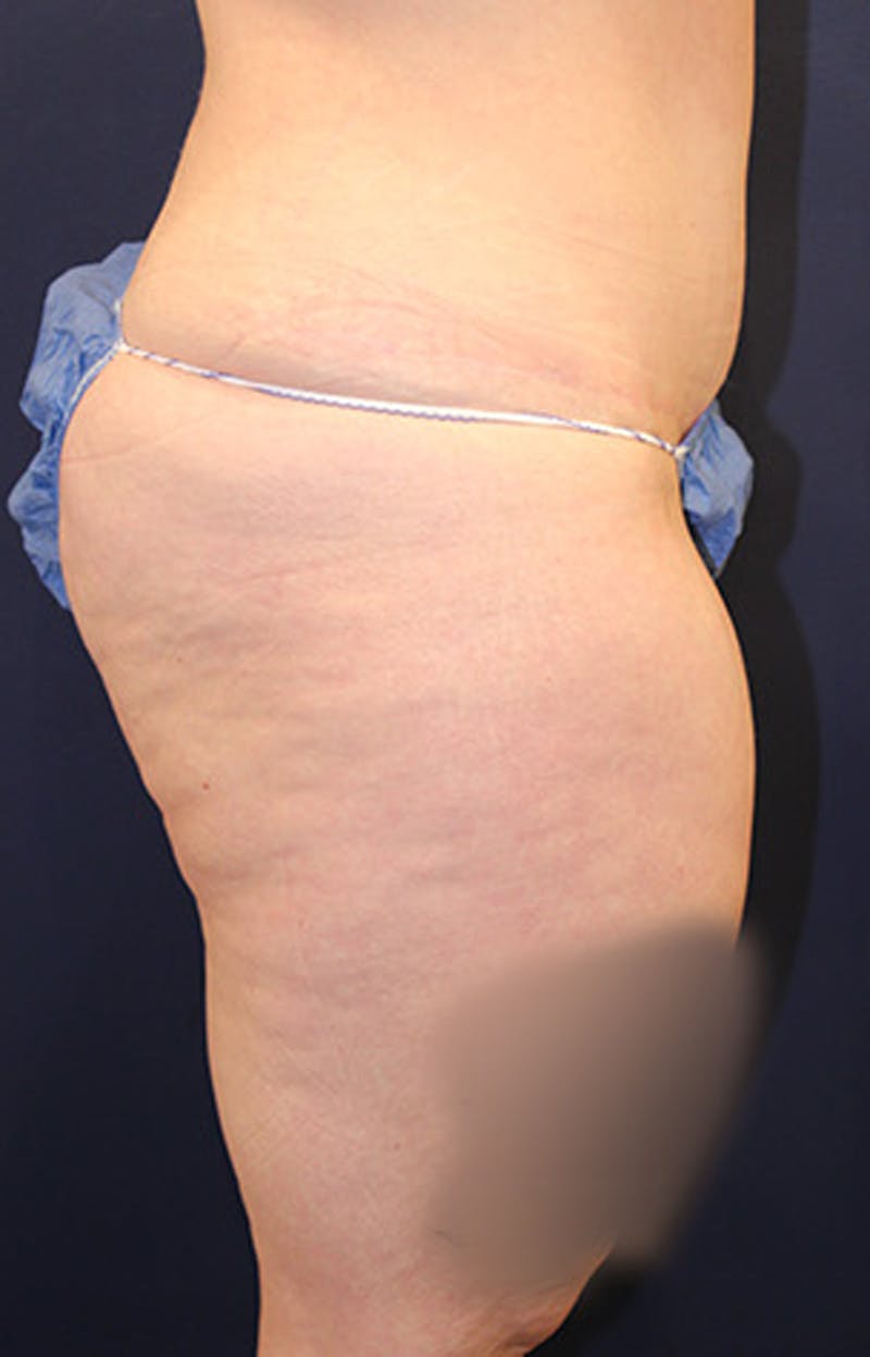 Tummy Tuck Before & After Gallery - Patient 174163193 - Image 6