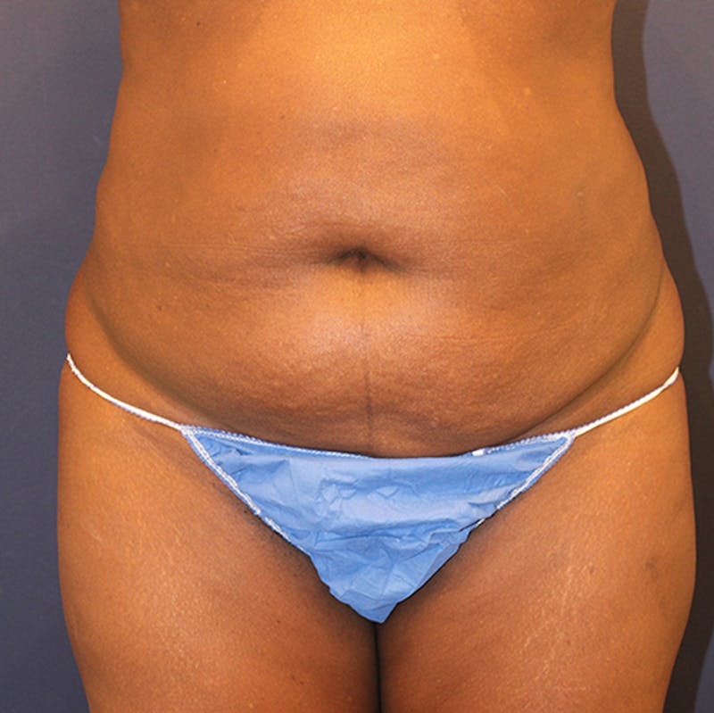 Tummy Tuck Before & After Gallery - Patient 174163205 - Image 1