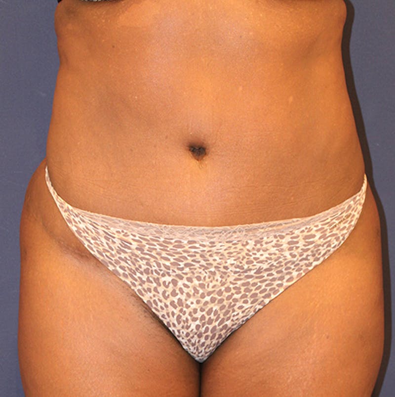 Tummy Tuck Before & After Gallery - Patient 174163205 - Image 2