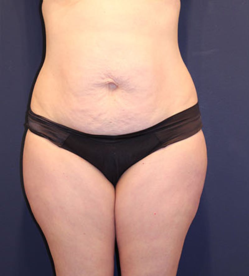 Tummy Tuck Before & After Gallery - Patient 174163213 - Image 1