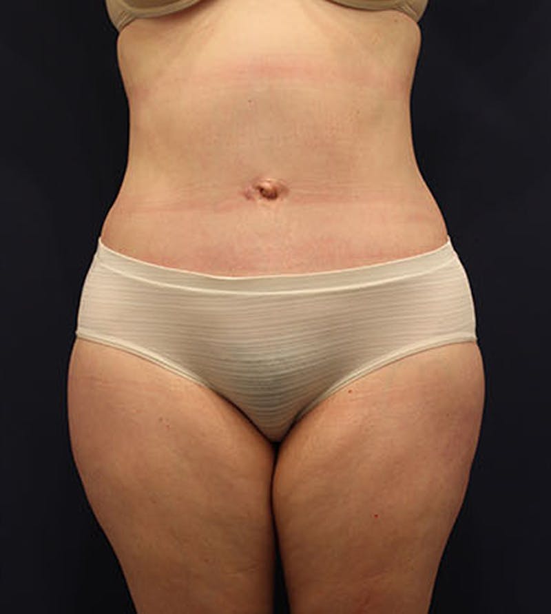 Tummy Tuck Before & After Gallery - Patient 174163213 - Image 2