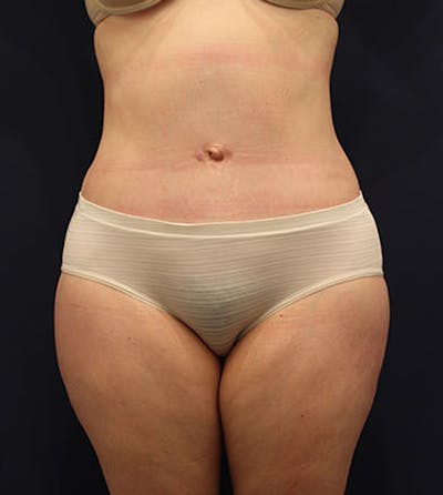 Tummy Tuck Before & After Gallery - Patient 174163213 - Image 2