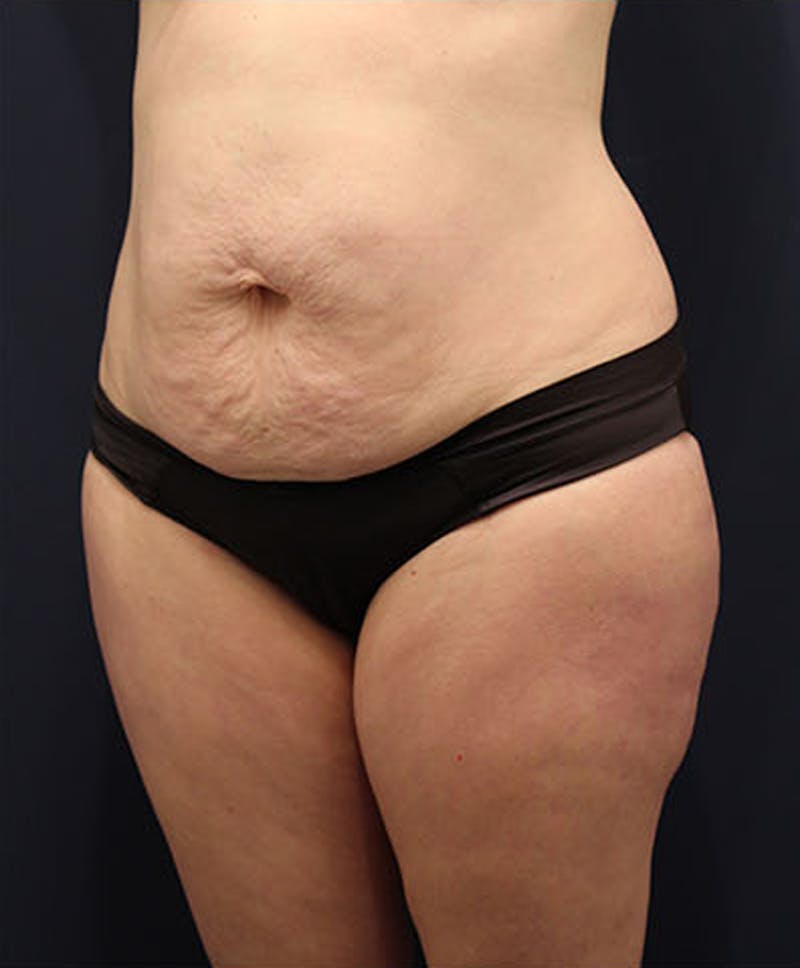 Tummy Tuck Before & After Gallery - Patient 174163213 - Image 3