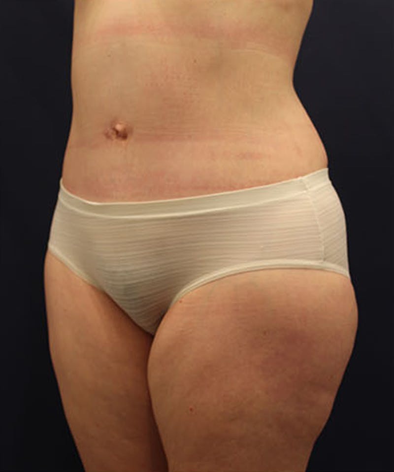 Tummy Tuck Before & After Gallery - Patient 174163213 - Image 4