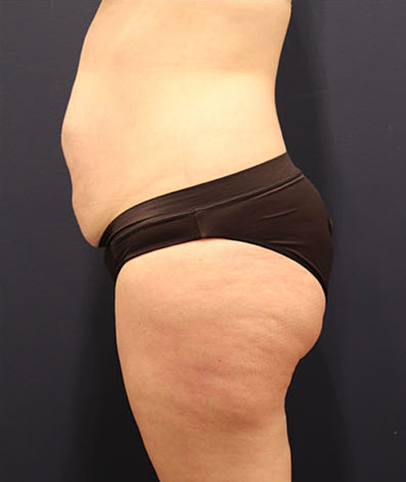 Tummy Tuck Before & After Gallery - Patient 174163213 - Image 5