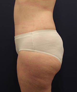 Tummy Tuck Before & After Gallery - Patient 174163213 - Image 6