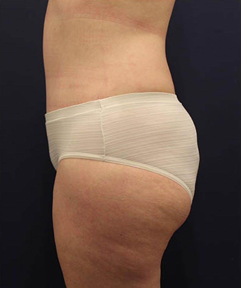 Tummy Tuck Before & After Gallery - Patient 174163213 - Image 6