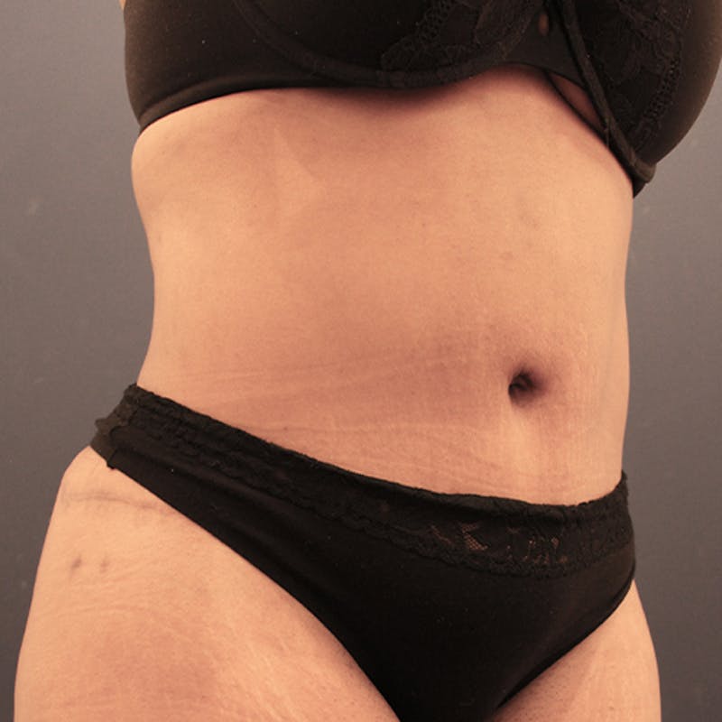 Tummy Tuck Before & After Gallery - Patient 174163226 - Image 4