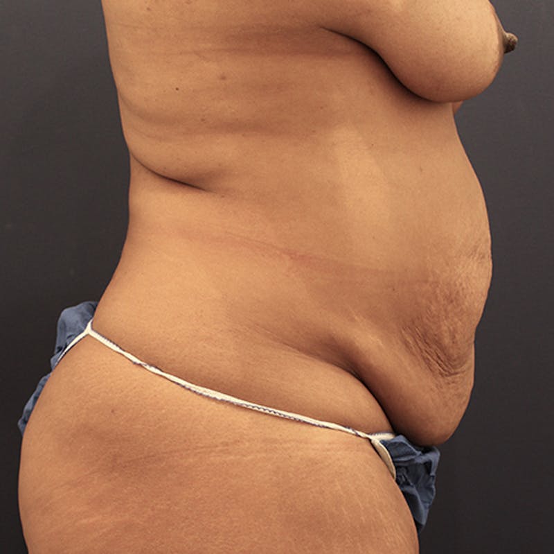 Tummy Tuck Before & After Gallery - Patient 174163226 - Image 5
