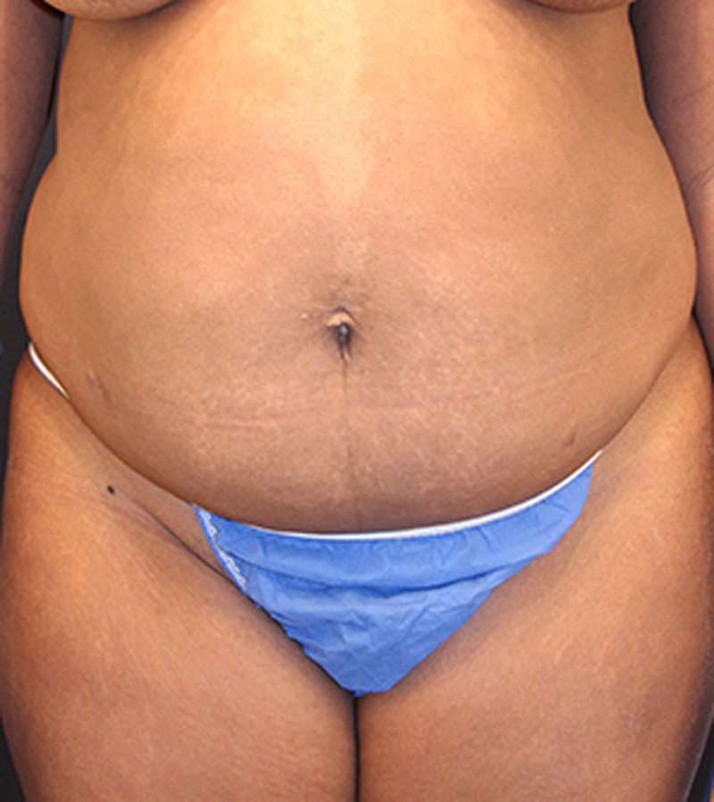 Tummy Tuck Before & After Gallery - Patient 174163233 - Image 1