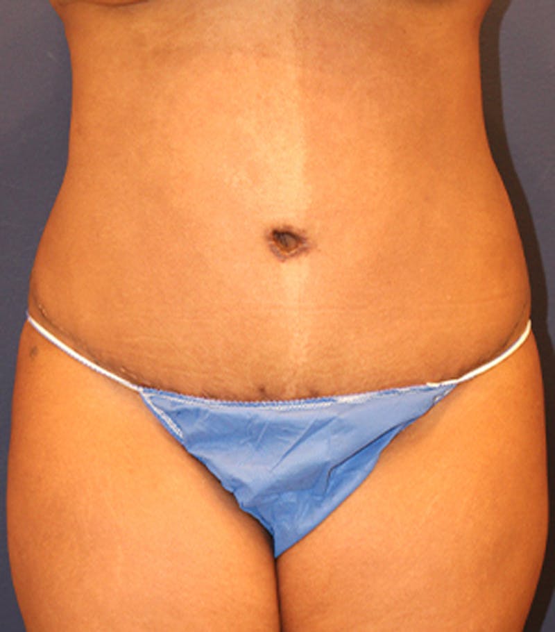 Tummy Tuck Before & After Gallery - Patient 174163233 - Image 2