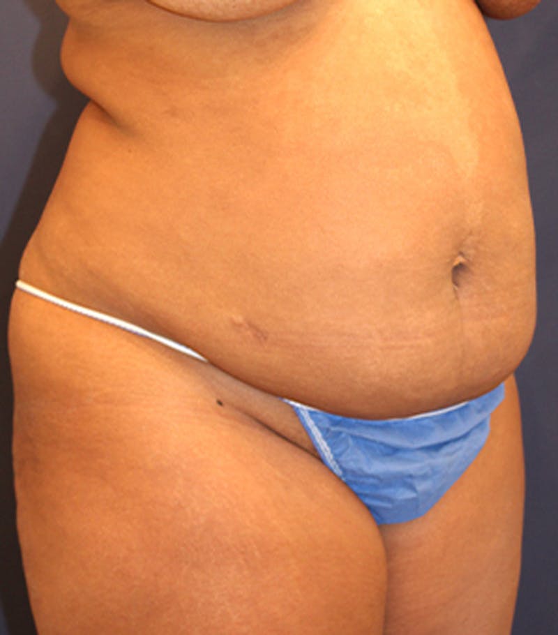 Tummy Tuck Before & After Gallery - Patient 174163233 - Image 3